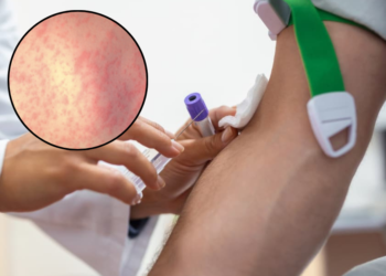 Colombia refuerza controles ante aumento de contagios de sarampión debido a 4 casos sospechosos